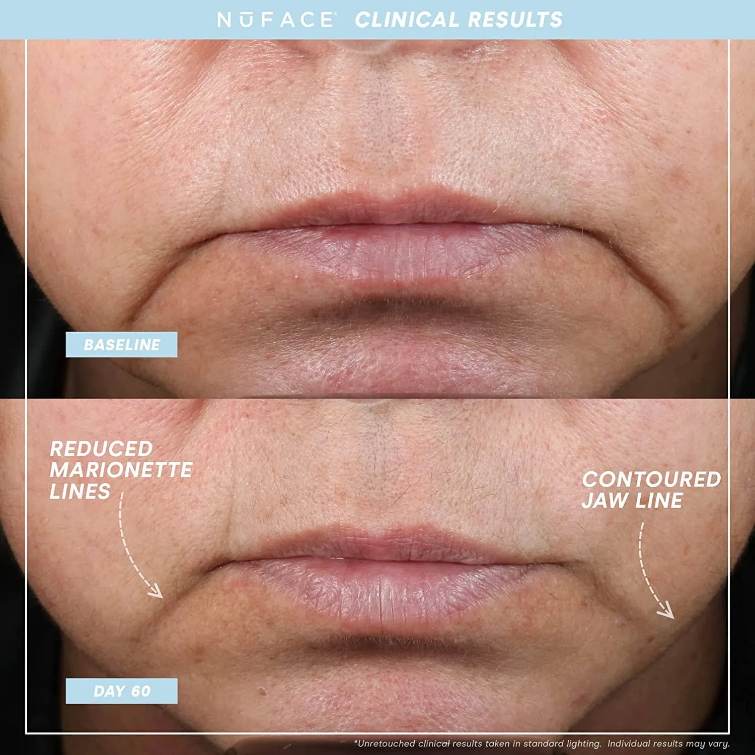 NuFACE TRINITY  Facial Toning Starter Kit